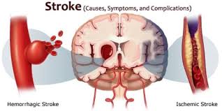 Taken together, they're the most common type of stroke (comprising about 87 percent of all cases, according to the centers for disease control and prevention). Stroke Causes Symptoms And Complications Assignment Point