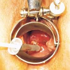 As the cancer grows, symptoms can include abnormal vaginal bleeding. Intradermal Technetium 99m Colloid Albumin Injection In An Early Stage Download Scientific Diagram