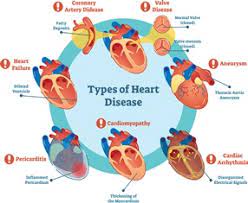 Ssdi Benefits For Cardiovascular Disease Alperin Law