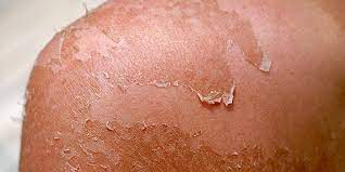 How to stop sunburn peeling. Sunburn Peeling How To Treat Peeling Skin Safely