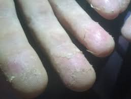 It may also be a sign of an immune system disorder or other disease. Keratolysis Exfoliativa Dermnet Nz