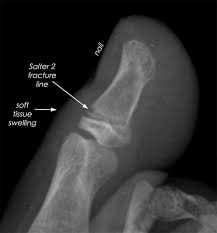 Stubbed that and broke it sideways. The Hidden Threat The Stubbed Toe And Finger Cincinnati Children S Blog