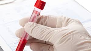 While no blood test can diagnose cancer, some blood tests can aid in the diagnosis of cancer. Cancer Detecting Blood Test Accurate Enough To Be Used As Early Screening Tool Study Ctv News