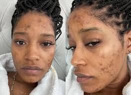 Pcos is caused by immature follicles which grow on the ovaries and subsequently cause an imbalance of hormones. Keke Palmer S Polycystic Ovary Syndrome Pcos Diagnosis Explained