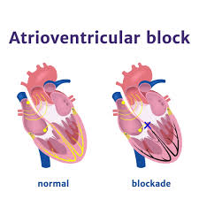 Image result for Atrioventricular Block