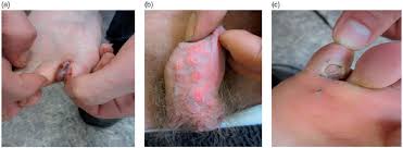 Image result for Secondary Syphilis