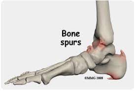 Maybe you would like to learn more about one of these? Bone Spur Pain Relief Treatment Suffolk Hampton Va