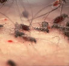 The spread of housing developments into suburbs close to midge. Biting Midges Vampires Of The Insect World Owlcation