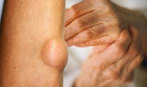 We did not find results for: Rheumatoid Arthritis Nodules Are A Symptom Express Co Uk