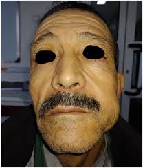 Extraoral examination revealing facial asymmetry
