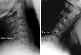 Please understand that our phone lines must be clear for urg. Assessment Of The Nearly Normal Cervical Spine Radiograph C2 C3 Pseudosubluxation In An Adult With Whiplash Injury Emergency Medicine Journal