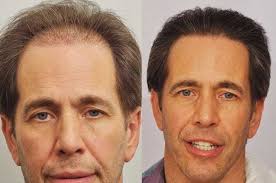 Great Hair Transplant Results with Small Sessions