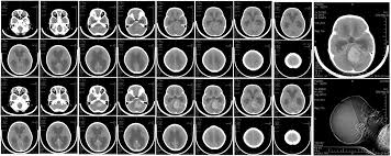 This results in a slowing down of the vital functions, and can cause death. Medulloblastoma Wikipedia