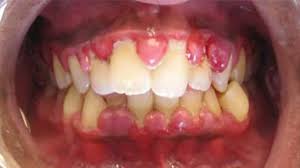 Place the toothbrush against the gums at a 45 degree angle. Gingival Hyperplasia Causes Symptoms And Treatment