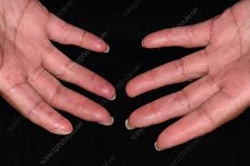 Image result for Connective Tissue Disorder