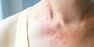 Even with the internet, identifying them can be a challenge given how many kinds of rash are out there. 18 Common Skin Rash Pictures How To Id Skin Rash Symptoms