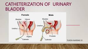 Image result for Urethral Catheterization