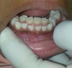The Soul Is Bone Occasionally A Permanent Tooth Begins To Erupt Dental Fun Kids Dental Health Dental