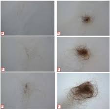 Resurfacing refers to the use of lasers, chemical peels, microneedling and microdermabrasion to address the outer layers of your skin. Hair Shedding Scale Scores Vary Between 1 Minimal Shedding To 6 Download Scientific Diagram