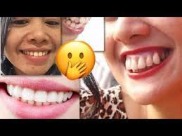 Gigi tonggos yang celahnya melebihi 3,5 mm termasuk dalam kategori parah. Memperbaiki Gigi Tonggos Tanpa Modal Cukup Pakai Tangan Lakukan 1 Menit Gigimu Masuk Kedalam Youtube Gigi Tangan Perawatan