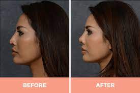 They may also experience bruising and swelling. Nose Job Surgery Rhinoplasty Sydney By World Renowned Facial Surgeon