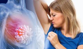 According to the american cancer society, just over 100,000 new cases of skin cancer are diagnosed in the united states each year. Breast Cancer Symptoms A New Lump Or Ricking In Your Armpit Could Be A Sign Express Co Uk