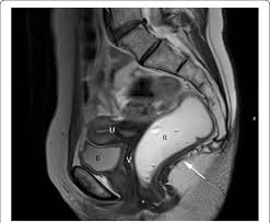 The pelvic region of the trunk includes the bony pelvis, the pelvic cavity (the space enclosed by the bony pelvis), the pelvic floo. Normal Female Pelvic Anatomy Sagittal Midline T2 Tse Image Download Scientific Diagram