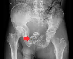 Image result for Chondrosarcoma