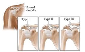 Commonly referred to as a complete ligament tear, the acl is split into two pieces and the knee is unstable. Acromioclavicular Shoulder Joint Sprain Low Level Laser Cold Laser Perth