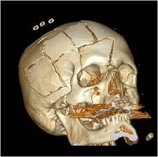 Fatal damage to the brain may occur without any fracture of the skull. Understanding Tbi