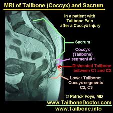 Pin En Tailbone Mri