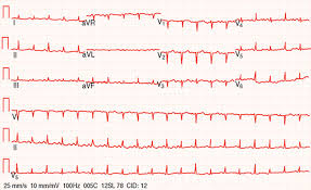 Acute pericarditis constrictive pericarditis pericardial effusion and cardiac tamponade. Pericardial Disease