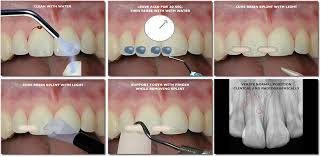 Image result for Tooth Luxation