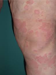 Image result for Papular urticaria
