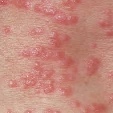 While most bug bites or stings can cause swelling, redness, pain or itching in the area that is affected, others can. 5 Types Of Bug Bites Causes Of Bug Bite Rashes