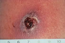 Image result for wolf spider bite skin