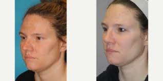 Timothy M. Greco, MD, FACS, Board Certified Facial Plastic Surgeon