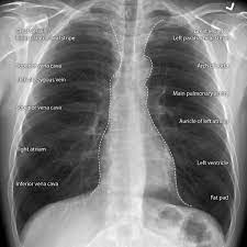If you'd like to support us and get something great in return, check out our osce checklist booklet containing over 100 compare each zone between lungs, noting any asymmetry (some asymmetry is normal and caused by the presence of various anatomical structures. Cardiomediastinal Outlines On Chest X Ray Radiology Case Radiopaedia Org