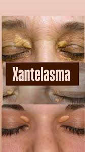 Image result for xantelasma