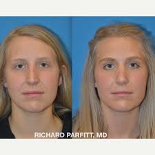 Richard Parfitt, MD, Board Certified Facial Plastic Surgeon