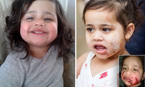 Toddler left with horrific facial injuries after being attacked by dog as  she played