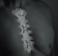 SternaLock® Blu - Denuo Medic