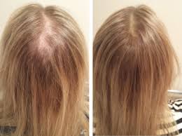 Hair loss in women is legit. What Causes Hair Loss In Women Female Hair Loss Help