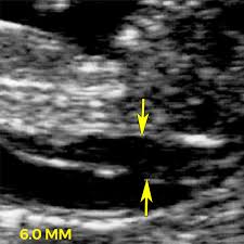 The amount of fluid is measured during an nt ultrasound scan: Nuchal Translucency Nt Scan Babycentre Uk