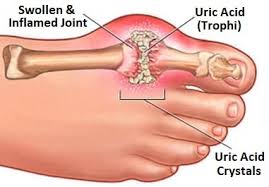 Image result for gout symptoms toe