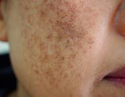 Www.pharma20.es las manchas de la cara o melasma son un trastorno muy común. Que Es El Melasma Y Como Tratarlo Pilar De Frutos Dermatologia Madrid