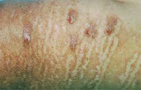 Image result for Neurodermatitis