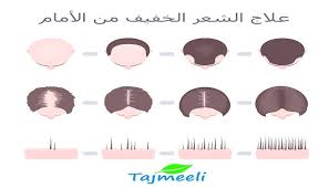 For more information and source,. Ø¹Ù„Ø§Ø¬ Ø§Ù„Ø´Ø¹Ø± Ø§Ù„Ø®ÙÙŠÙ Ù…Ù† Ø§Ù„Ø§Ù…Ø§Ù… Ø¹Ù„Ø§Ø¬ Ø§Ù„Ø´Ø¹Ø± Ø§Ù„Ø®ÙÙŠÙ Ù…Ù† Ø§Ù„Ø§Ù…Ø§Ù… Ù„Ù„Ø±Ø¬Ø§Ù„ ÙˆØ§Ù„Ù†Ø³Ø§Ø¡ ØªØ¬Ù…ÙŠÙ„ÙŠ