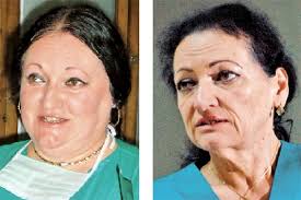 Principala și cea mai comună dintre ele — este , răceala ochilor ca urmare a unui curent sau de vânt puternic sau hipotermie. CurÄƒ De SlÄƒbire Cum A SlÄƒbit Doctorul Monica Pop 40 De Kilograme FÄƒrÄƒ NutriÈ›ionist