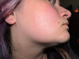 What causes itchy dry face bumps?